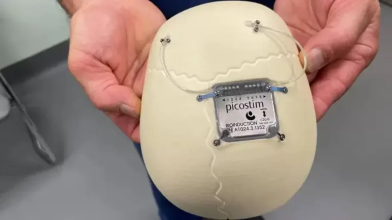 Innovación médica: Primer implante de neuroestimulador en el cráneo de un niño para el tratamiento de la epilepsia severa
