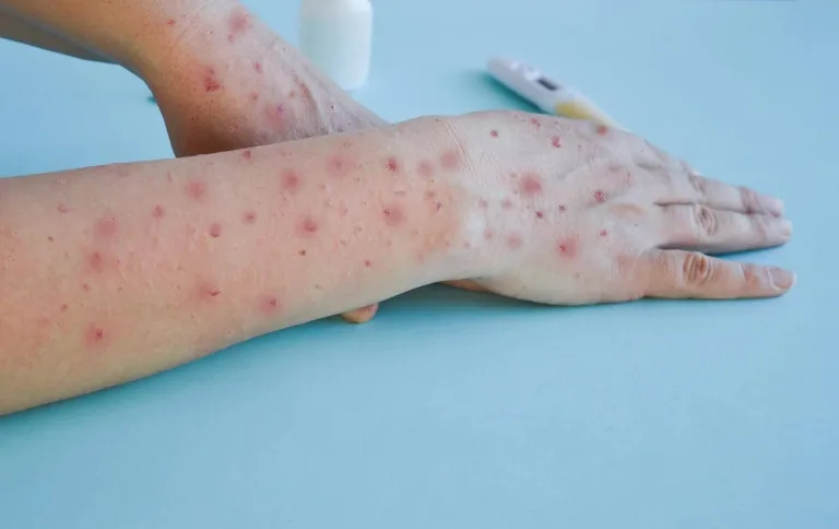 En Chile, confirman un caso de Mpox (Viruela del Mono)