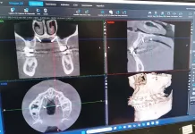 Hospital de Curicó incorpora tecnología de odontología digital para modernizar sus tratamientos dentales-3
