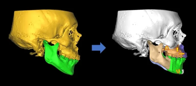 Hospital de San Fernando realiza su primera cirugía ortognática y mejora la calidad de vida de un adolescente